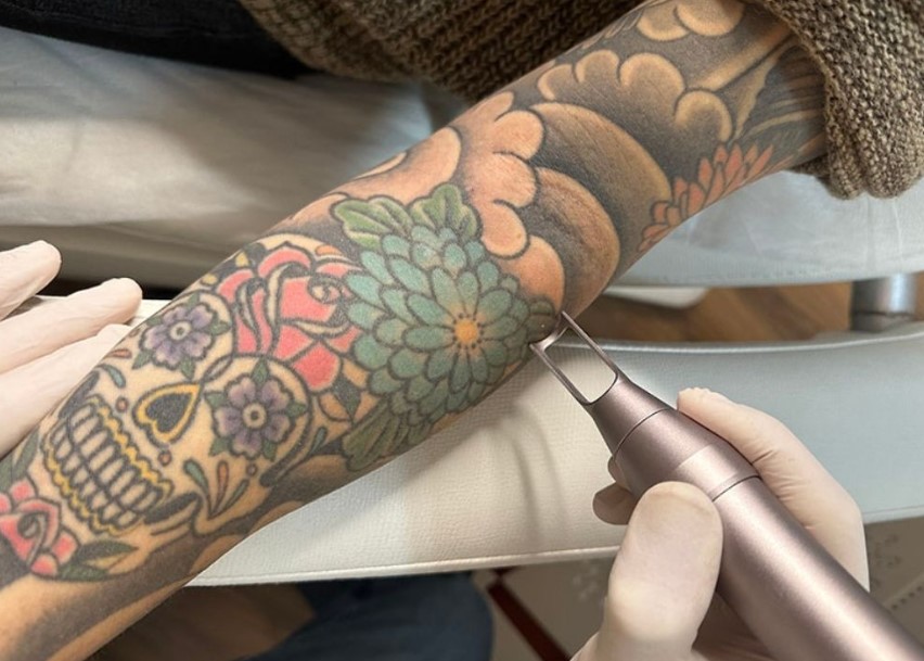 Antalya Dövme Sildirme İşlemleri Cildinize Zarar Verir Mi?