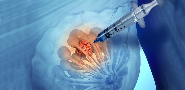 Biyopsi Nedir, Ne Amaçla Yapılır?