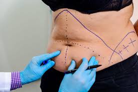 VaserLiposuction Nedir? Klasik Liposuction’dan Farkı Ne?