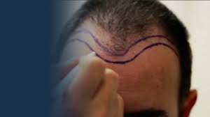 En İyi 10 Saç Ekimi Kliniği (2026) – Fiyatlar, Yöntemler ve Doğallığın Sırrı