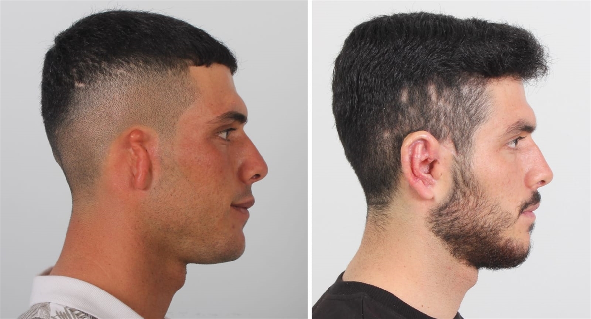 Göğüs kafesinden alınan kıkırdakla kulak kepçesi yapıldı