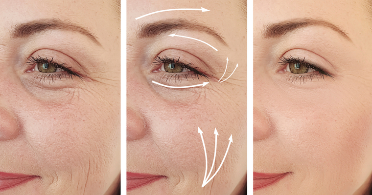 Kırışıklık Karşıtı Cilt Bakımı Hakkında Bilinmesi Gerekenler!