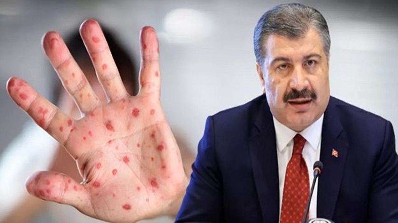 Sağlık Bakanı Fahrettin Koca: Türkiye'de 5 maymun çiçeği vakası tespit edildi
