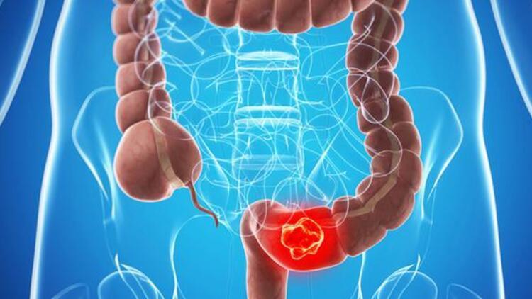 SEYDİŞEHİR İLÇE SAĞLIK MÜDÜRLÜĞÜ KOLON KANSERİ BİLGİ NOTU