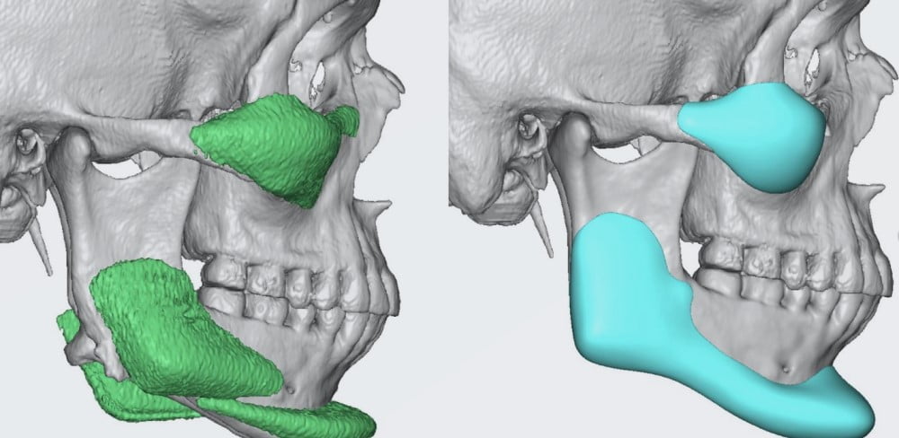 Yüz İmplant Türleri Neler? Kimler Yüz İmplant Yapar?