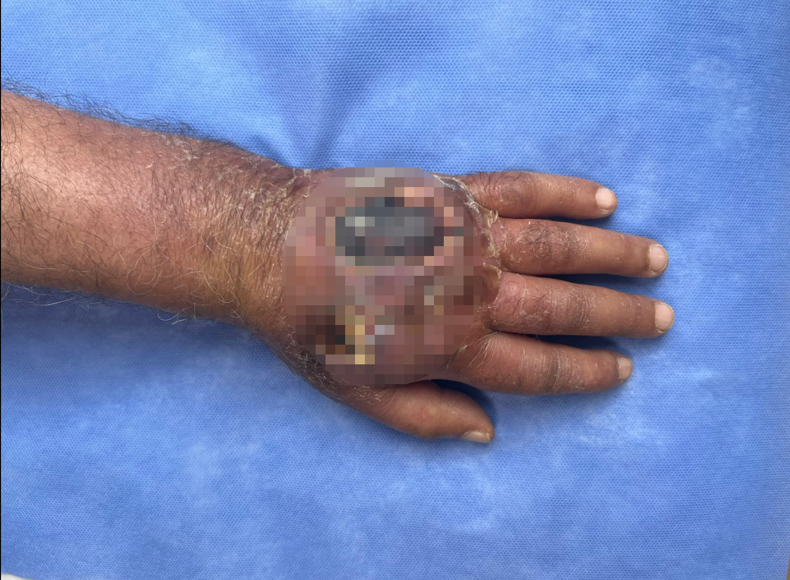 İstanbul - Hırsızın ısırığı kolundan ediyordu; vaka literatüre girmeye aday  - Görsel 1