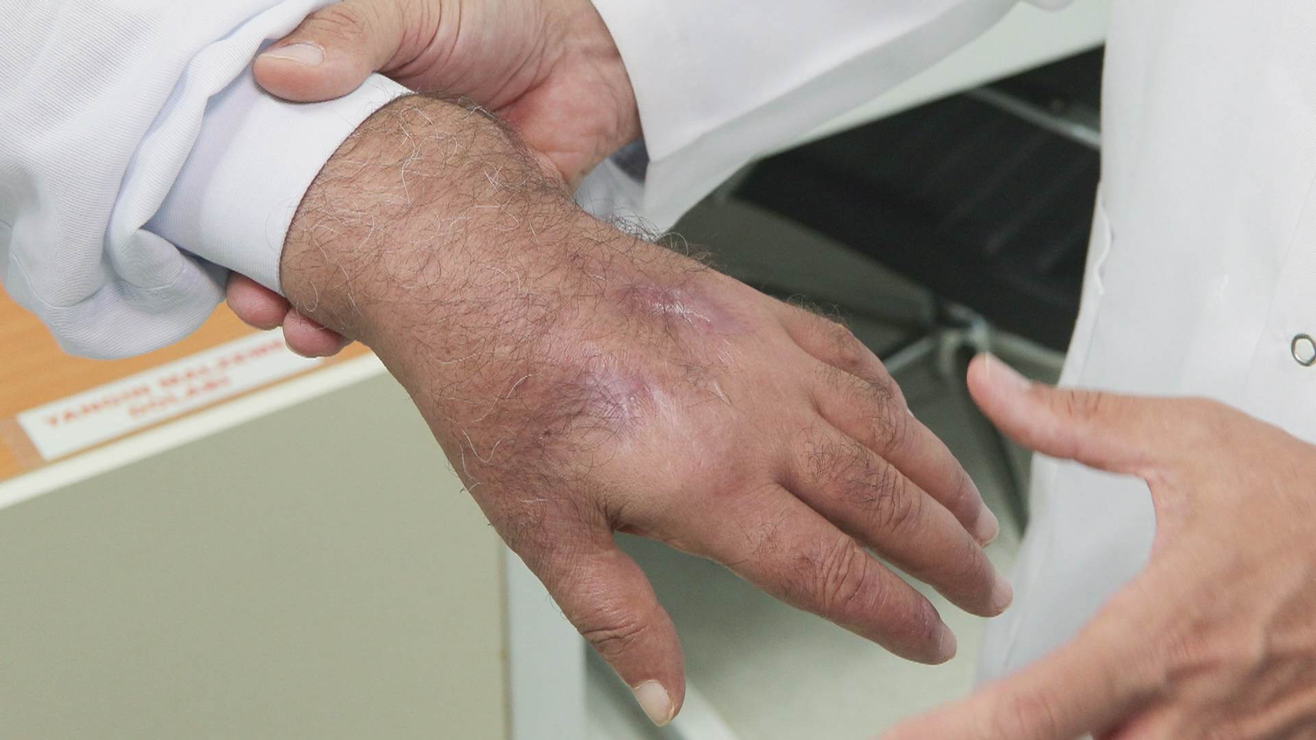 İstanbul - Hırsızın ısırığı kolundan ediyordu; vaka literatüre girmeye aday  - Görsel 3