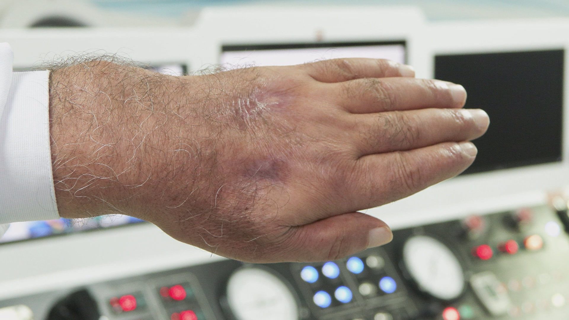 İstanbul - Hırsızın ısırığı kolundan ediyordu; vaka literatüre girmeye aday  - Görsel 6