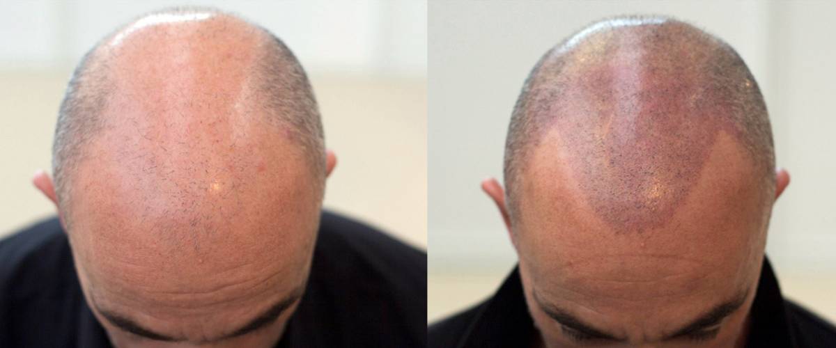 Saç Simülasyonu: Estetik ve Doğal Görünümün Buluştuğu Nokta