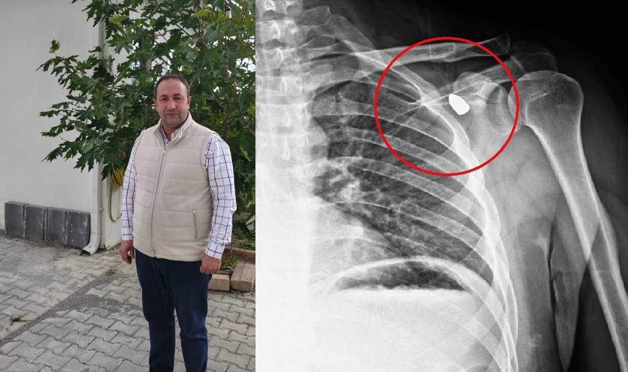 Konya'da bir kişinin vücudundaki yorgun mermi 6 yıl sonra çıkarıldı