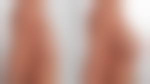 Meme Büyütme Estetiği: Hayalinizdeki Görünüme ve Özgüvene Kavuşun