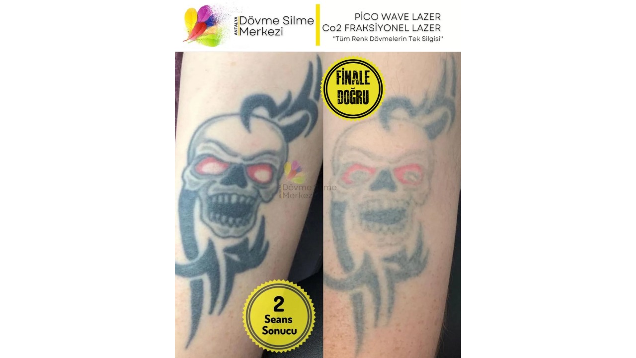 Antalya Dövme Silme Merkezi Lara Şubesinde Dövme Sildirme Fiyatları Uygun Mu?