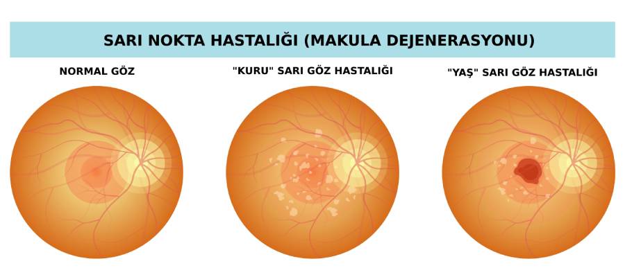 Sarı Nokta Hastalığı (Makula Dejenerasyonu) Nedir?