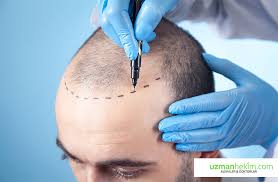 En İyi 10 Saç Ekimi Kliniği: Türkiye'de Güvenilir ve Başarılı Adresler