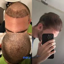 Saç Ekimi: Estetik ve Özgüvenin Yeniden İnşası