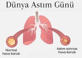 2 MAYIS DÜNYA ASTIM GÜNÜ
