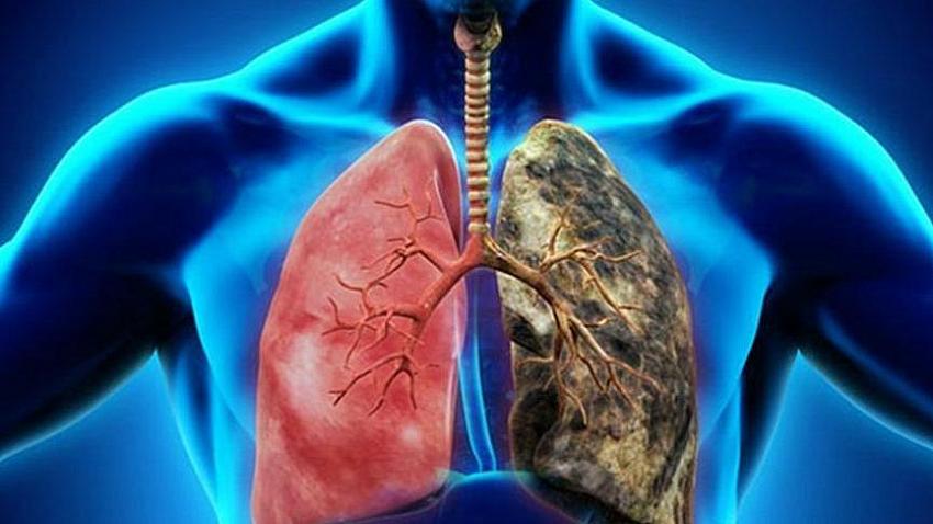 Akciğer kanserinde erken teşhis, yaşam süresi ve tedavi şansını artırıyor