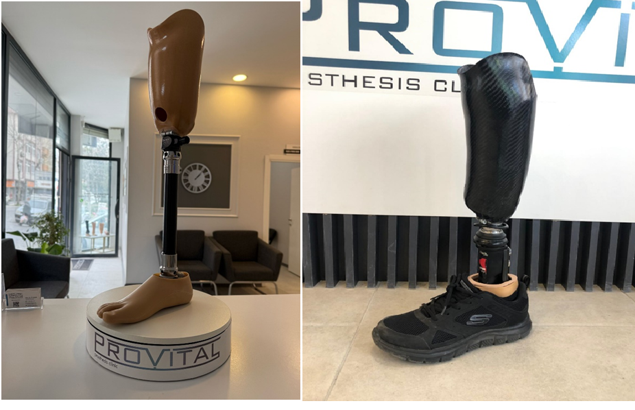 Diz Altı Protez Bacak Nedir?2025 Fiyatları Hakkında Bilgilendirme