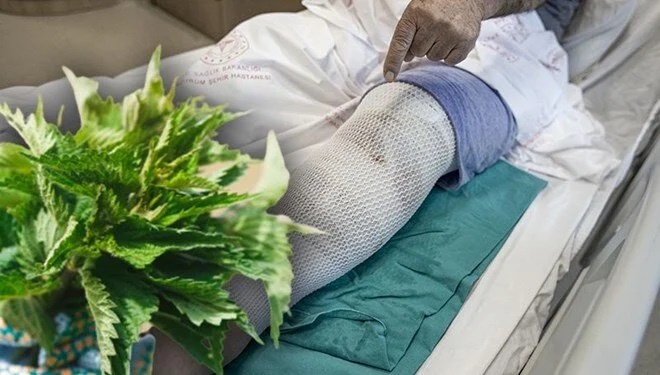 Erzurum'da bir vatandaş, yakınlarının tavsiyesiyle ağrıyan bacaklarına ısırgan otu sardı hastanelik etti