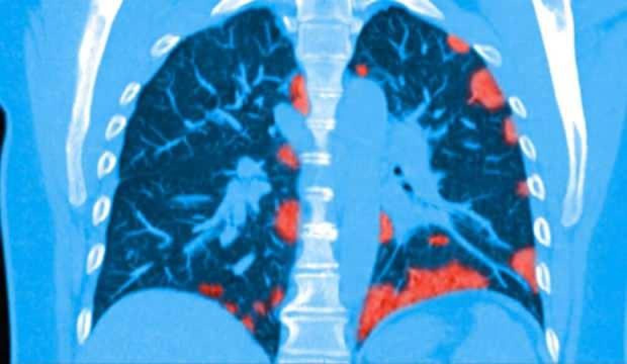 Koronavirüsten ölen kişinin ciğerleri görüntülendi