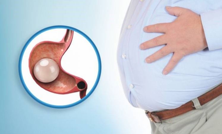 Mide balonu ile fazla kilodan kurtulmak