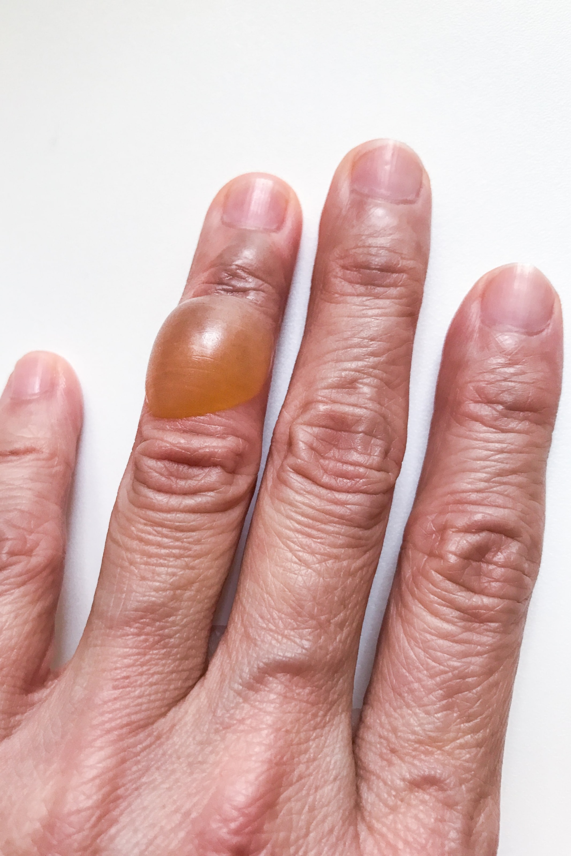 Su Toplaması Nasıl Geçer: Tedavi ve Önleme Yöntemleri