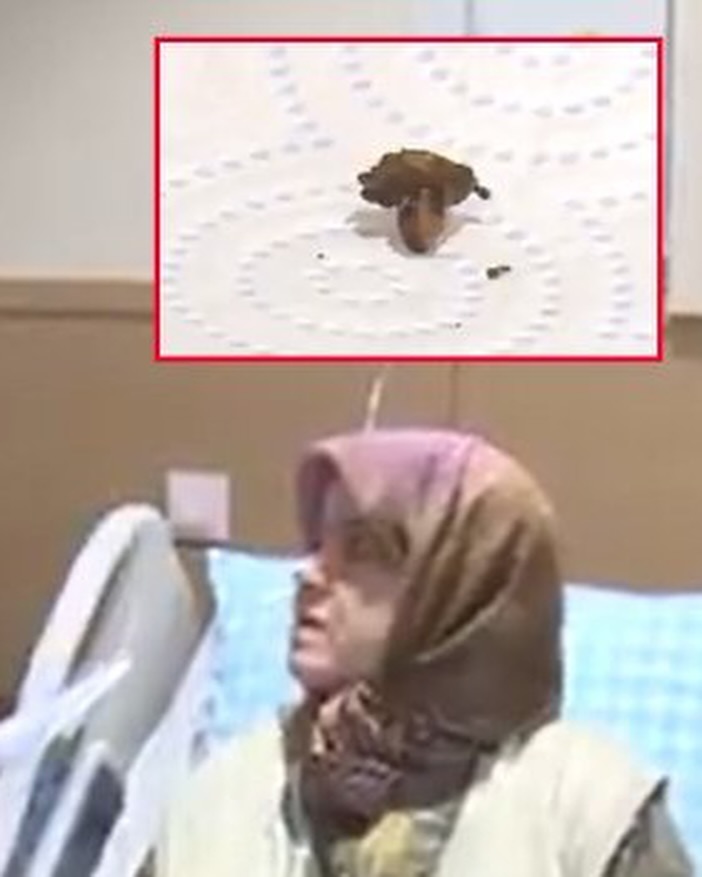 Tıp Literatürüne Geçecek Vaka: 68 Yaşındaki Kadının Akciğerinden Kolonya Tıpası Çıktı - Görsel 1