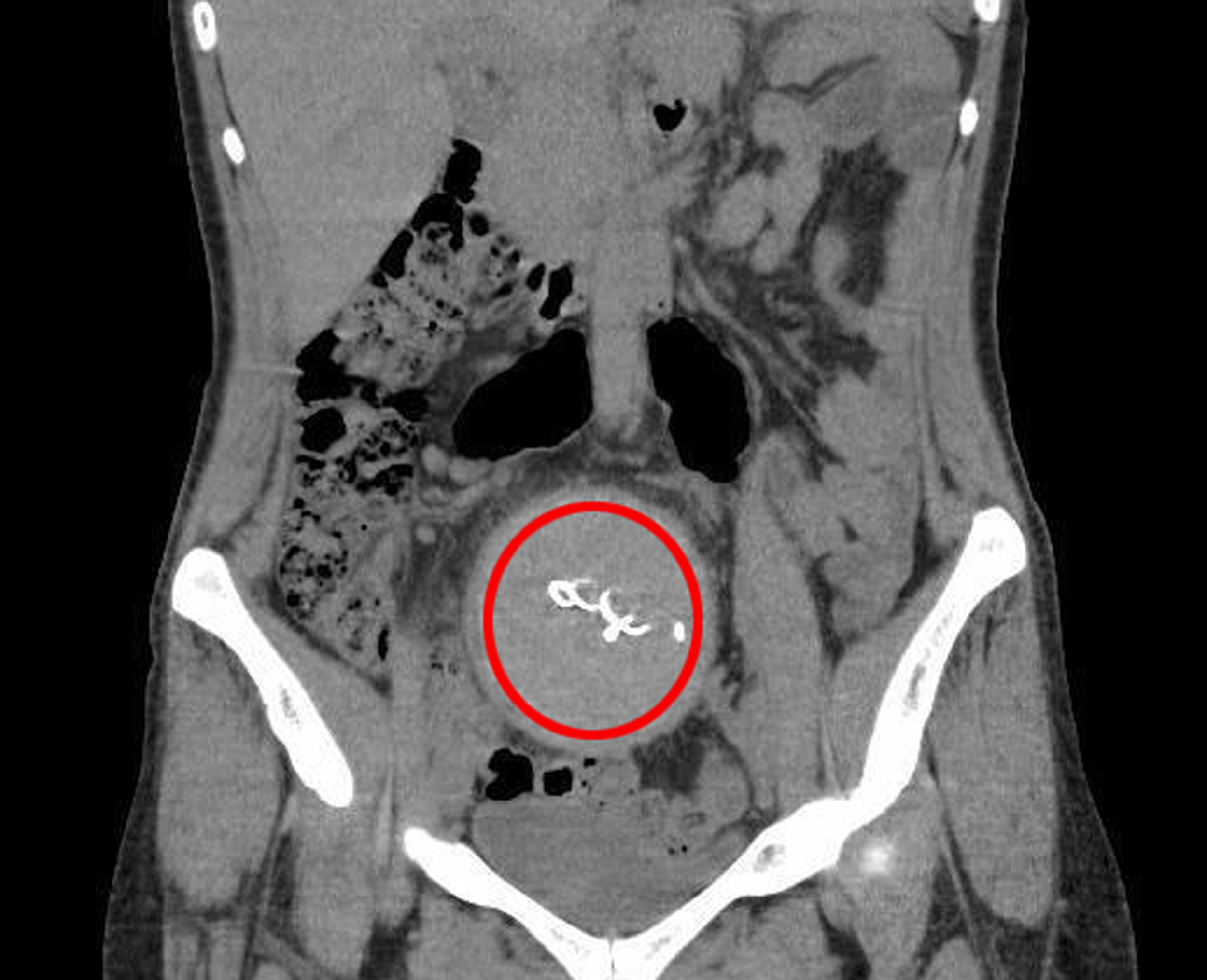 Doğumda unutuldu, iki yıl sonra ortaya çıktı: Gazlı bez ihmaline soruşturma - Görsel 4